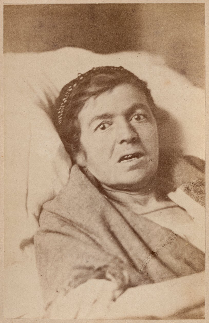 الصرع الهستيري ، تقلص الوجه ، اللوحة الثامنة من "Iconographie Photographique de La Salpetriere" بورنفيل و ب. ريجنارد ، باريس ، 1876 (طبعة زيلية) بواسطة بول ريجنارد