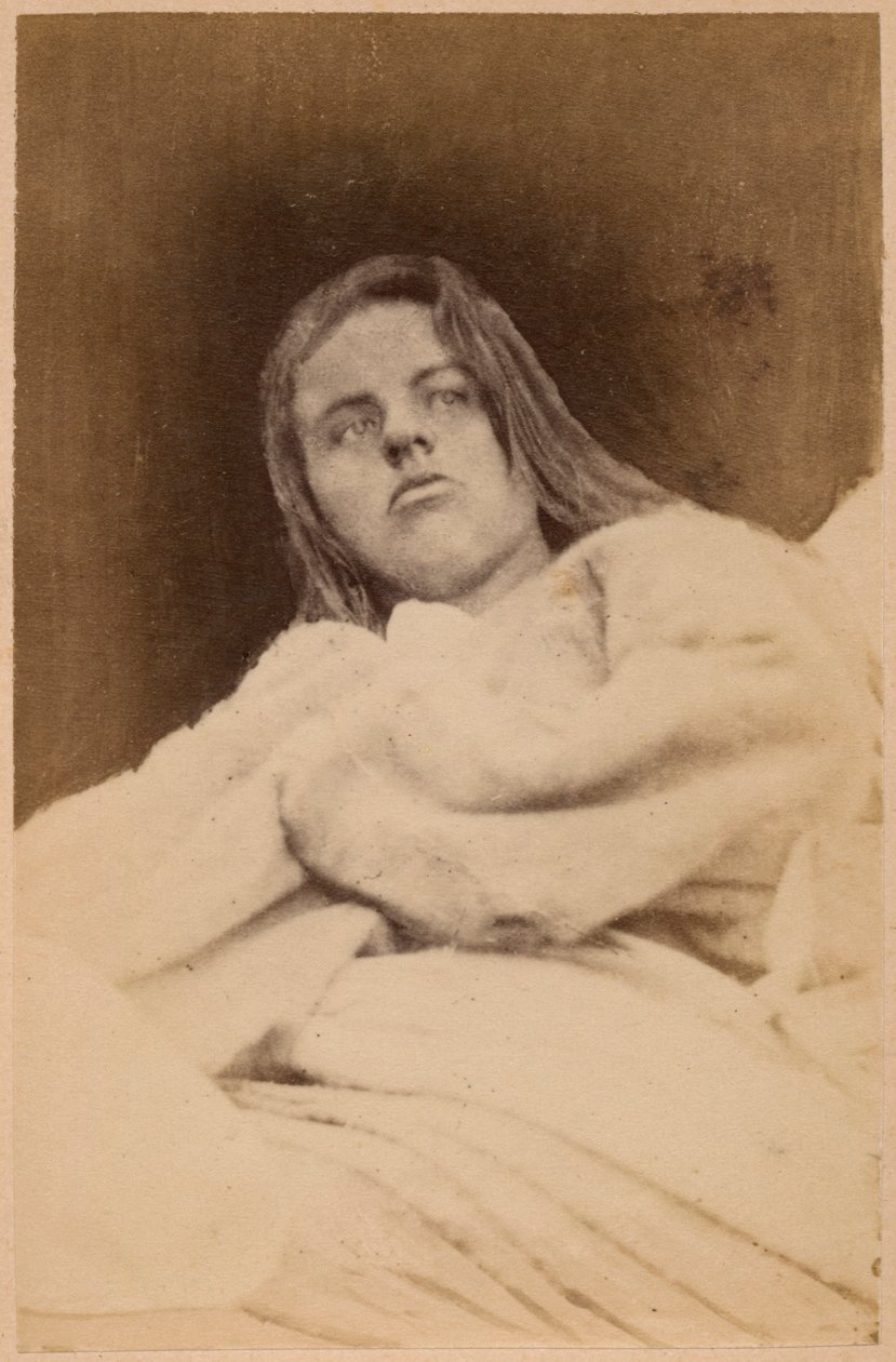 الصرع الهستيري ، الهلوسة ، الازدراء ، اللوحة الحادية والثلاثون من `` Iconographie Photographique de La Salpetriere &39;&39; بورنفيل و ب. ريجنارد ، باريس ، 1876 (طبعة زيلية) بواسطة بول ريجنارد