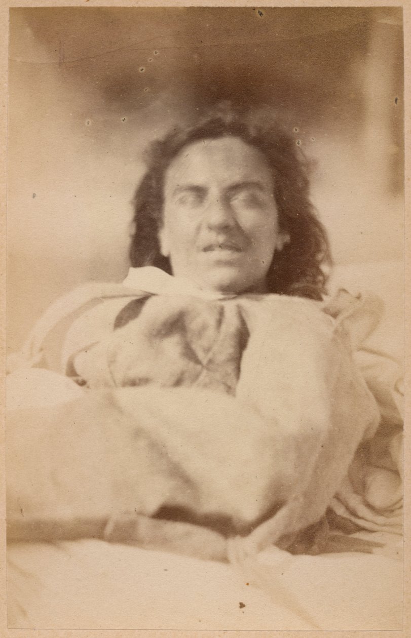 الصرع الهستيري ، الهلوسة ، السخرية ، اللوحة الثانية والثلاثون من `` Iconographie Photographique de La Salpetriere &39;&39; بورنفيل و ب. ريجنارد ، باريس ، 1876 (طبعة زيلية) بواسطة بول ريجنارد
