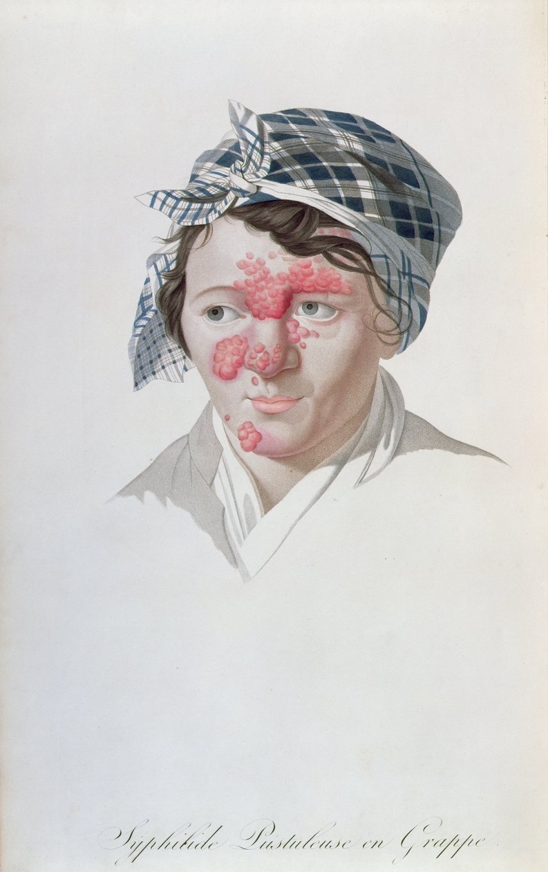 البثور العنقودية الزهرية ، من كتاب البارون جان لويس عليبرت (1768-1837) 1838 بواسطة سلفادور تريسكا