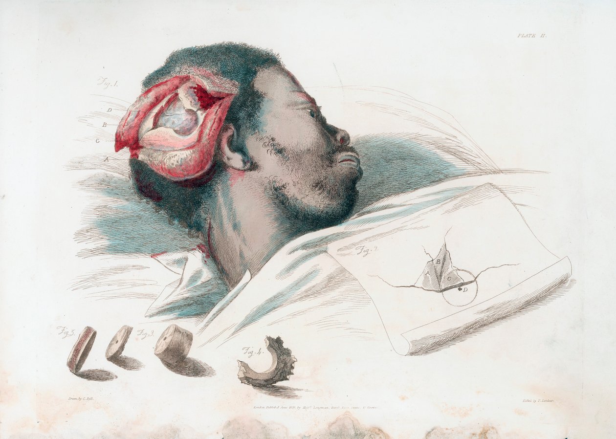 منظر لجرح في الجمجمة بعد حفر وإزالة قطعة عظم محطمة أسفل اليسار ، 1821 بواسطة توماس لاندسير
