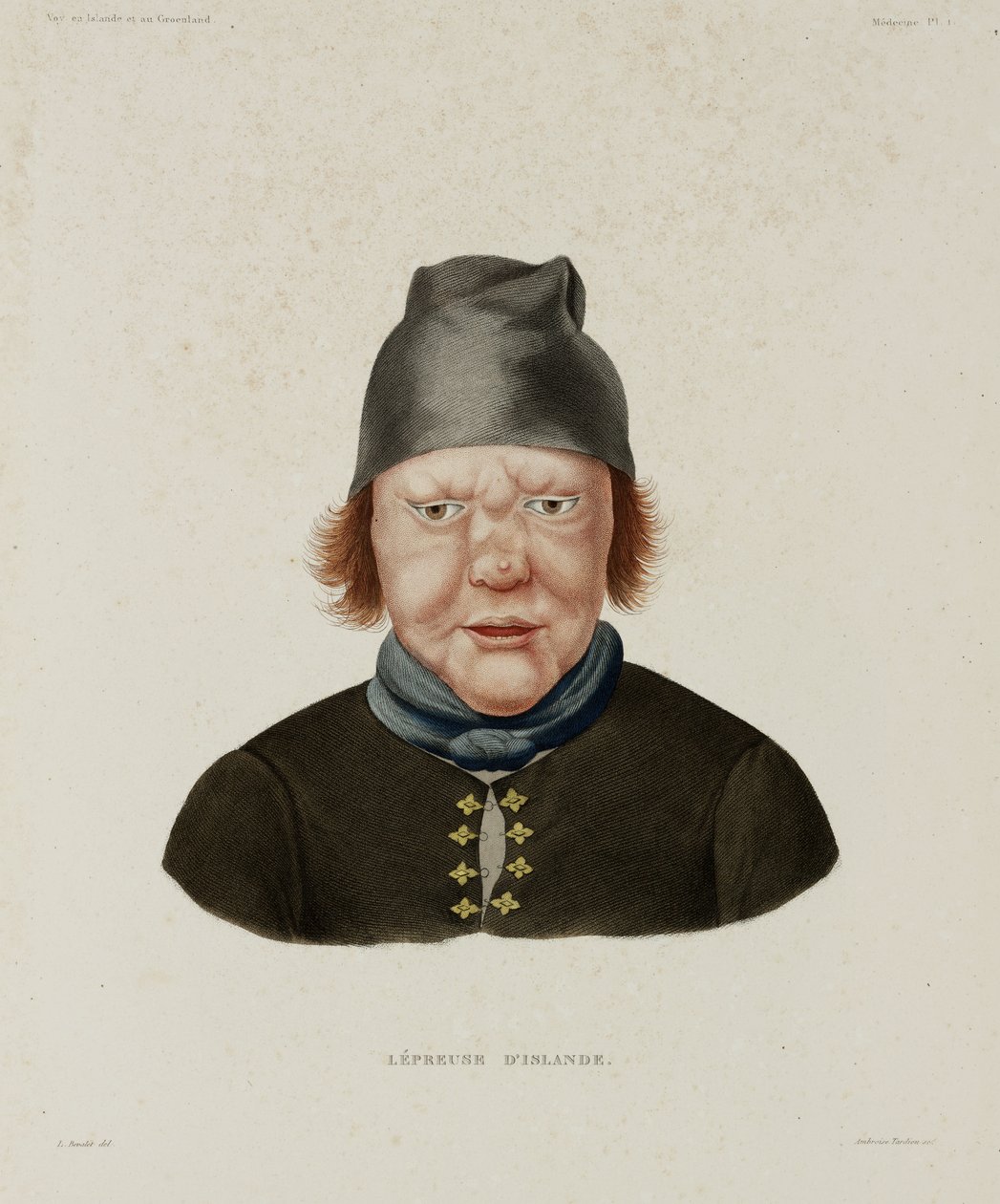 Diseases, Leprosy Female leper, Iceland, early 19th century بواسطة غير معروف