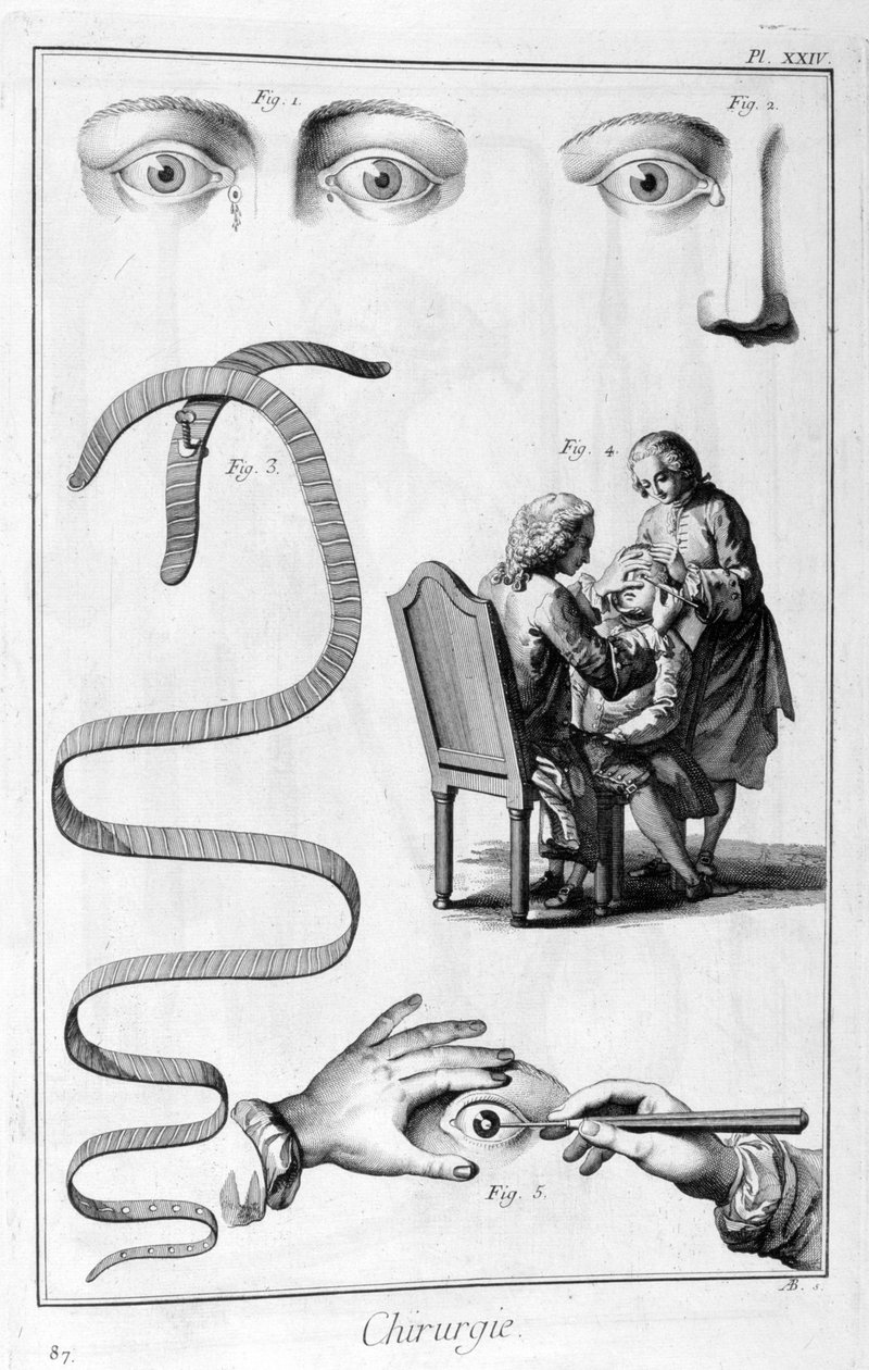 جراحة العيون 1751-1777 بواسطة غير معروف