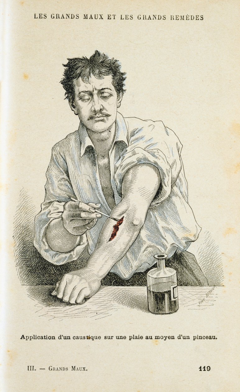 طلاء الجرح بمحلول مطهر ، c1890 بواسطة غير معروف
