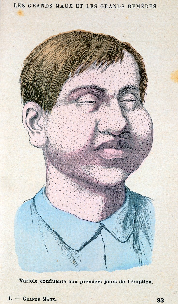 ضحية الجدري ، c1890 بواسطة غير معروف