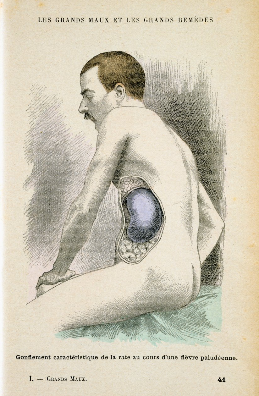 تضخم الطحال النموذجي لمريض الملاريا ، c1890 بواسطة غير معروف