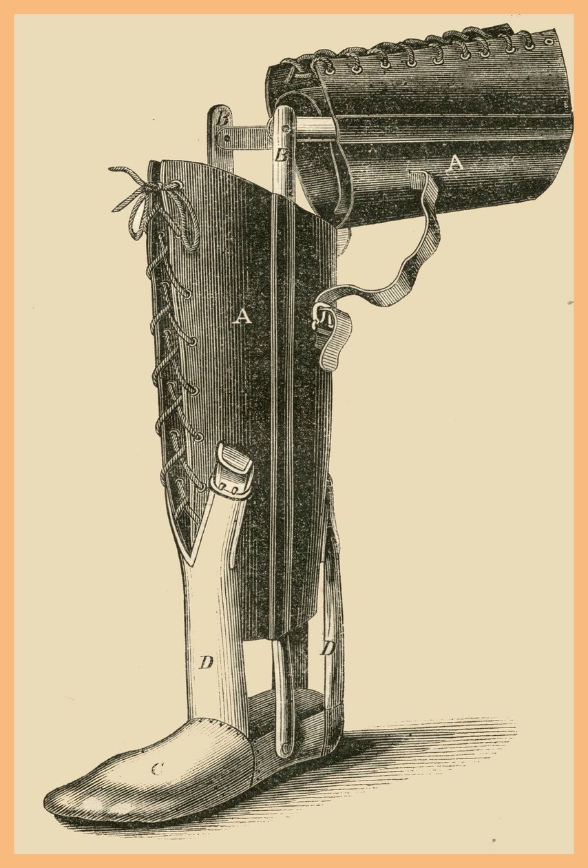 استبدال الساق بواسطة فنان غير معروف