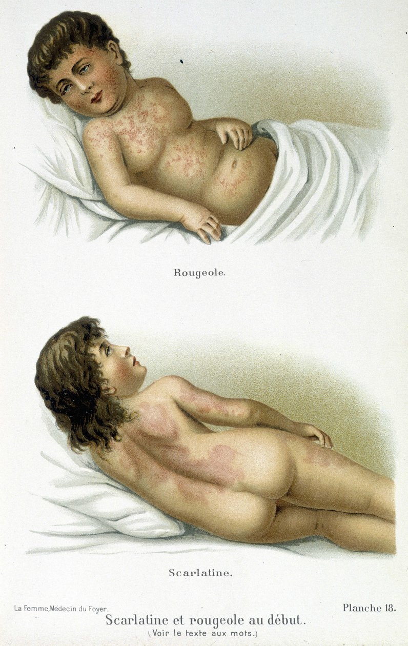 الحمى القرمزية والحصبة - القرن التاسع عشر بواسطة فنان غير معروف