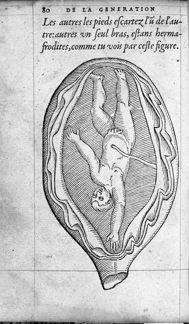 مكانة الجنين في الرحم أثناء الحمل. نقش من "De la generation des enfants" للطبيب والجراح الفرنسي أمبرواز باري (1509-1590) من القرن السادس عشر بواسطة فنان غير معروف