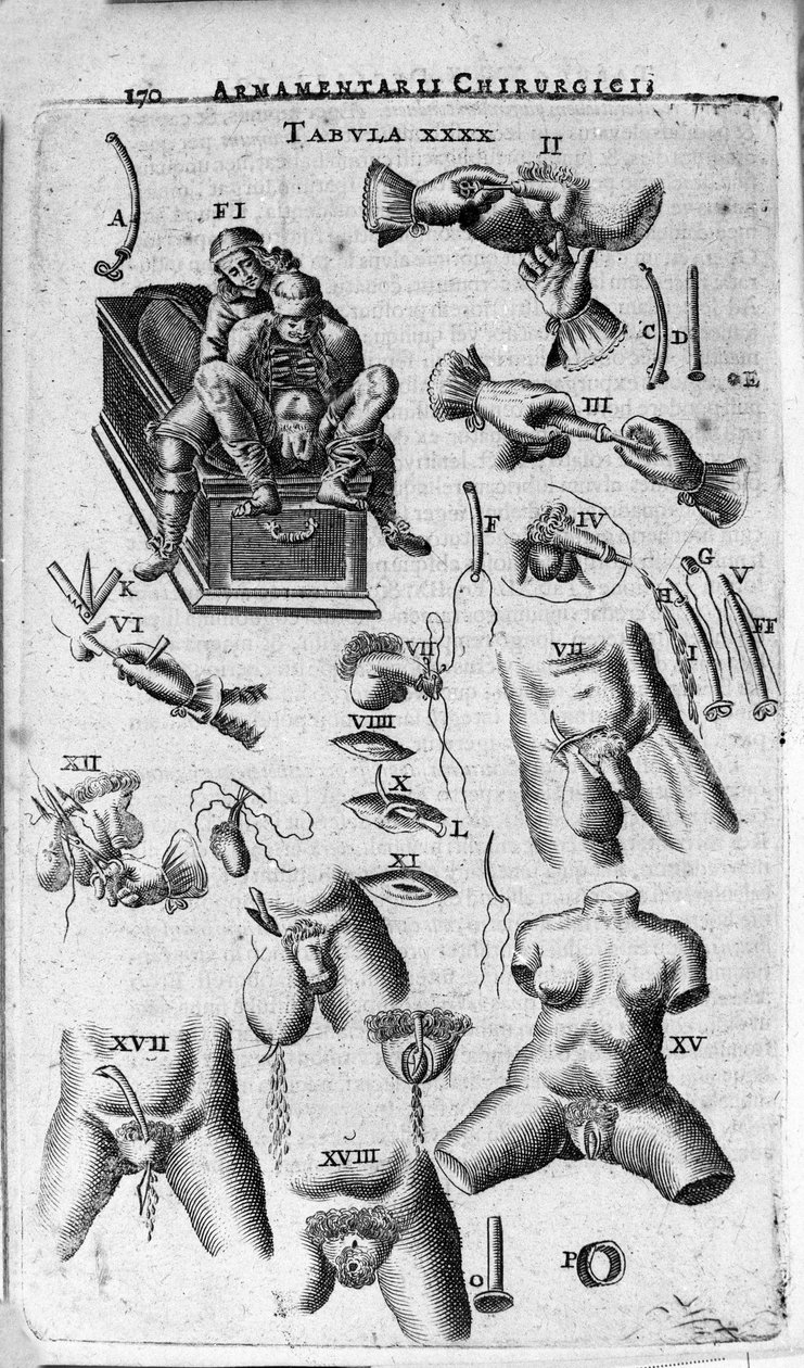 التدخلات الجراحية على الجنسين. نقش في "Armamentarium Surgical" بواسطة J. Scultetus ، البندقية بواسطة فنان غير معروف