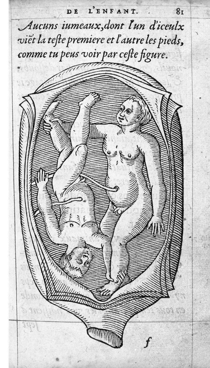 مكانة الجنين في الرحم أثناء الحمل. نقش من "De la generation des enfants" للطبيب والجراح الفرنسي Ambroise Pare (1509-1590) من القرن السادس عشر بواسطة فنان غير معروف