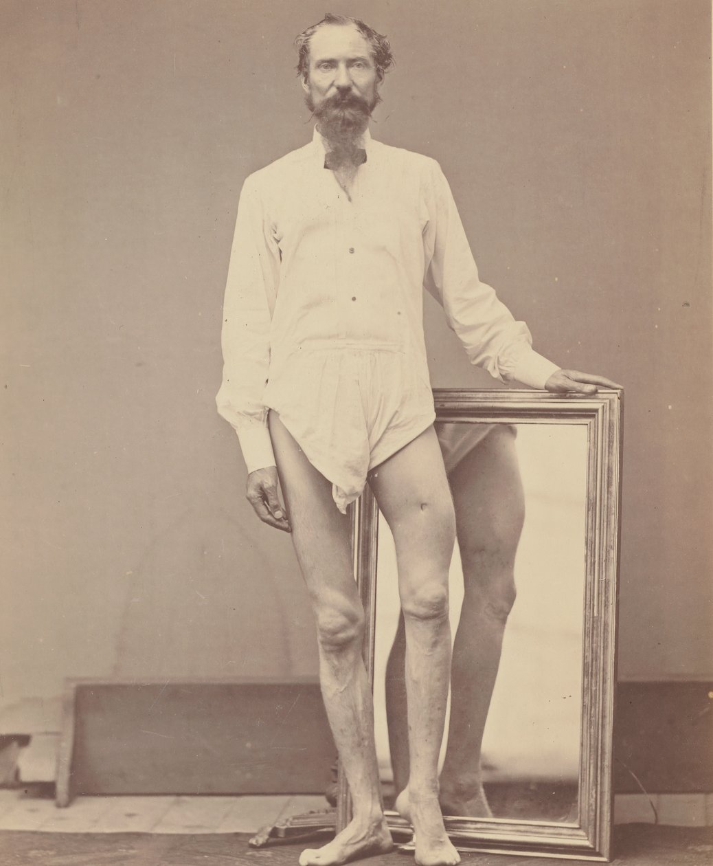 جرح ناري في الثلث الأوسط من عظم الفخذ الأيسر ، 1865-1867. بواسطة ويليام اتش بيل
