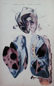 سكتة القلب والرئتين ، لوحة توضيحية من "Anatomie pathologique du corps humain" بقلم جان كروفيلهير (1791-1874) ، نُشرت في باريس