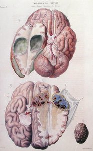 أورام الدماغ السرطانية ، من "Anatomie Pathologique du Corps Humain" بقلم جان كروفيلهير (1791-1874) 1828-42 (نقش ملون)