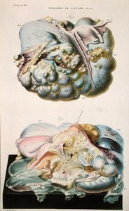 أمراض المبايض ، من "التشريح المرضي لجسم الإنسان" بقلم جان كروفيلهير (1791-1874) 1828-42 (نقش ملون)