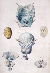 أمراض المثانة والبروستاتا ، من "Anatomie Pathologique du Corps Humain" بقلم جان كروفيلهير (1791-1874) 1828-42 (نقش ملون)