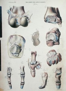 أمراض المفاصل ، من "التشريح المرضي لجسم الإنسان" بقلم جان كروفيلهير (1791-1874) 1828-42 (نقش ملون)