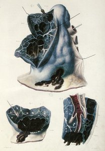 أمراض الرئتين ، من "التشريح المرضي لجسم الإنسان" بقلم جان كروفيلهير (1791-1874) 1828-42 (نقش ملون) بواسطة انطوان شزال