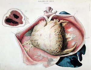 التهاب التامور ، لوحة تصور أمراض القلب من "Anatomie pathologique du corps humaine" بقلم جان كروفيلهير (1791-1874) ، نُشر في باريس