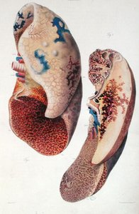 الالتهاب الرئوي ، من "التشريح المرضي لجسم الإنسان" لجان كروفيلهير (1791-1874) 1828-42 (نقش ملون)