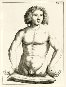 مثال على العيوب الخلقية ، من التمارين العملية إلى طريقة العلاج بواسطة فريدريك ديكرز ، 1694 بواسطة المدرسة الهولندية
