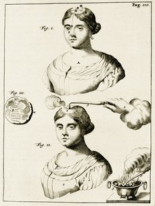 علاج مرضى الصرع ، من التمارين العملية إلى طريقة الشفاء بواسطة فريدريك ديكرز ، 1694 بواسطة المدرسة الهولندية