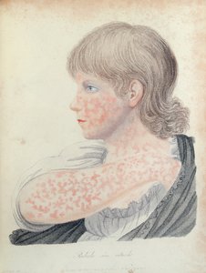 الحصبة الألمانية ، رسم توضيحي لكتاب روبرت ويلان (1757-1812) ، 1808 (نقش الألوان) بواسطة مدرسة اللغة الإنجليزية