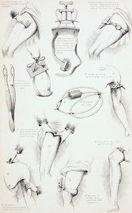 طرق القبض على النزيف ، ج .1890 بواسطة مدرسة اللغة الإنجليزية