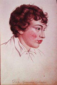 رقعة جافة من 'Description des Maladies de la Peau' للبارون جان لويس أليبرت (1768-1837) بواسطة المدرسة الفرنسية