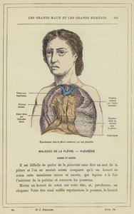 Epanchement dans la plevre occasionne par une pleuresie (colour litho) بواسطة المدرسة الفرنسية