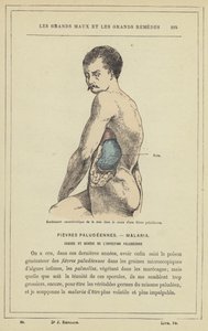 التورم المميز للطحال في سياق حمى الملاريا (لون ليثو) بواسطة المدرسة الفرنسية