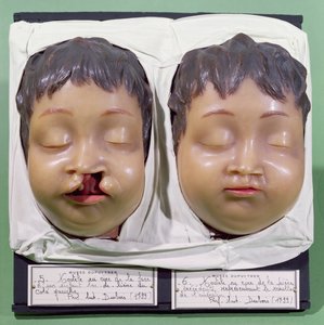نموذج يظهر وجه طفل قبل وبعد عملية لتصحيح آفة شعرية قام بها أنطوان دوبوا (1756-1837) عام 1799 (شمع) بواسطة المدرسة الفرنسية