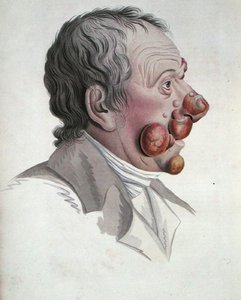 Mycosis Fongoide ، من كتاب للبارون جان لويس أليبرت (1768-1837) 1838 (نقش ملون) بواسطة المدرسة الفرنسية