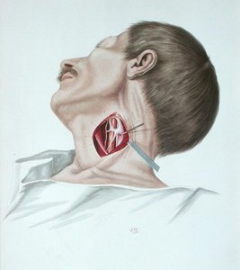 عملية تمدد الأوعية الدموية ، من "Selecta Praxis Medico-Chirurgica" بقلم ألكسندر أوفرت ، باريس بواسطة المدرسة الفرنسية