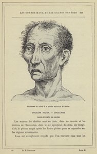Physionomie du malade a la periode asphyxique du cholera (colour litho) بواسطة المدرسة الفرنسية