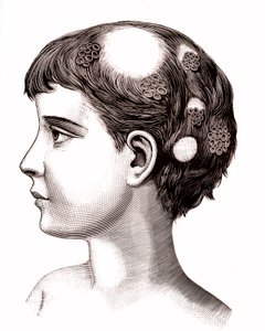 السعفة على الطفل. 1887 (نقش) بواسطة المدرسة الفرنسية