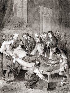 أول عرض عام لاستخدام الأثير المستنشق كمخدر جراحي في عام 1846 من قبل طبيب الأسنان الأمريكي ، ويليام توماس جرين مورتون ، من "Les Merveilles de la Science" ، نُشر عام 1870 بواسطة المدرسة الفرنسية