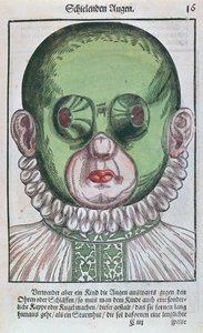 قناع لعلاج الحول ، من Ophthalmodouleia بواسطة جورج بارتيش (1535-1636) نشر في دريسدن عام 1583 (طباعة لوح خشبي ملون) بواسطة المدرسة الألمانية