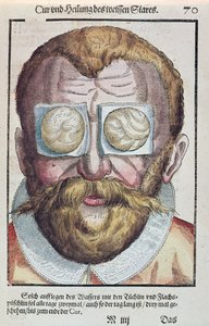 علاج حالة العين ، من طب العيون من قبل جورج بارتيش (1535-1636) المنشور في دريسدن عام 1583 (طبعة خشبية ملونة) بواسطة المدرسة الألمانية