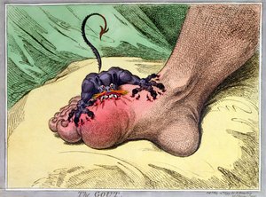 النقرس ، نشرته هانا همفري عام 1799 (نقش أرضي ملون يدويًا)