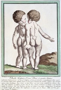 Siamese children - in “” Les deviations de la nature”” by Régnault بواسطة جان بابتيست ريغنولت