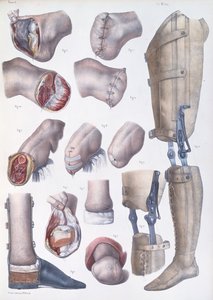 بتر الأطراف والأطراف الصناعية ، لوحة من "Traite Complet de l&39;Anatomie de l&39;Homme" بقلم جان باتيست مارك بورجري (1797-1849) 1866-67