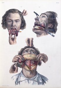 عملية على الفك السفلي ، صفيحة من "Traite Complet de l&39;Anatomie de l&39;Homme" لجان بابتيست مارك بورجري (1797-1849) 1866-67