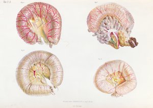 السطح الخارجي للأمعاء المصابة بالكوليرا ، من Anatomie Pathologique du Cholera Morbus ، بواسطة نيكولاي إيفانوفيتش بيروغوف (1810-1881) المنشور في سانت بطرسبرغ ، 1849 بواسطة المدرسة الروسية
