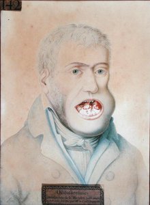الساركوما العظمية في الفك السفلي ، تم إجراء العملية بنجاح بواسطة Guillaume Dupuytren (1777-1835) (قلم رصاص على ورق) بواسطة المدرسة الفرنسية