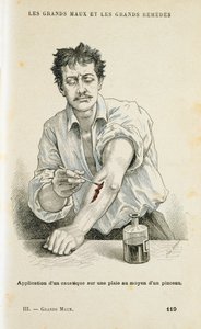 طلاء الجرح بمحلول مطهر ، c1890 بواسطة غير معروف