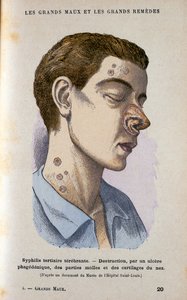 أعراض المرحلة الثالثة من مرض الزهري ، القرن التاسع عشر بواسطة غير معروف