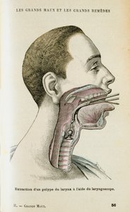 استخدام منظار الحنجرة للمساعدة في إزالة الورم من الحلق ، c1890 بواسطة غير معروف