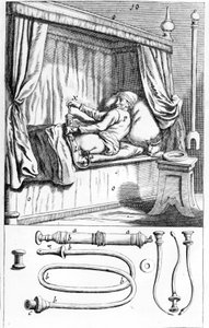 كليستير (للحقن الشرجية) بواسطة يوهانس سكلبتتوس "" Armamentarium Surgical "". البندقية 1665 بواسطة فنان غير معروف