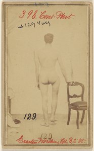 كسر في الثلث العلوي من عظم الفخذ. إيراستوس ورثن، من شركة كورب. B. 2nd Vermont Vols. البالغ من العمر 25 عاماً - مقيم في ستوكبريدج في فيرمونت. بواسطة فنان غير معروف